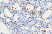 Lung tissue from mice with pulmonary fibrosis that were infected with corisin-secreting bacteria showed signs of acute exacerbation and lung tissue death.