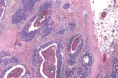 Illinois researchers added infrared capability to a standard optical microscope, enabling digital biopsies like this one – computational “stains” without adding any dyes or chemicals to the tissue sample.