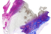 Breast tissue is computationally stained using data from infrared imaging without actually staining the tissue, enabling multiple stains on the same sample. From left, the image shows a Hematoxylin and Eosin stain (pink-blue), molecular staining for epithelial cells (brown color) and Masson's trichrome(blue, red at right).