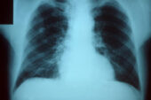 Researchers report they have found a way to disrupt the spread of antibiotic-resistance genes among S. pneumoniae bacteria, which can contribute to pneumonia, meningitis and other dangerous ailments.