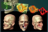 Using engineering design methods, researchers model custom bone replacement implants for facial reconstruction surgery.