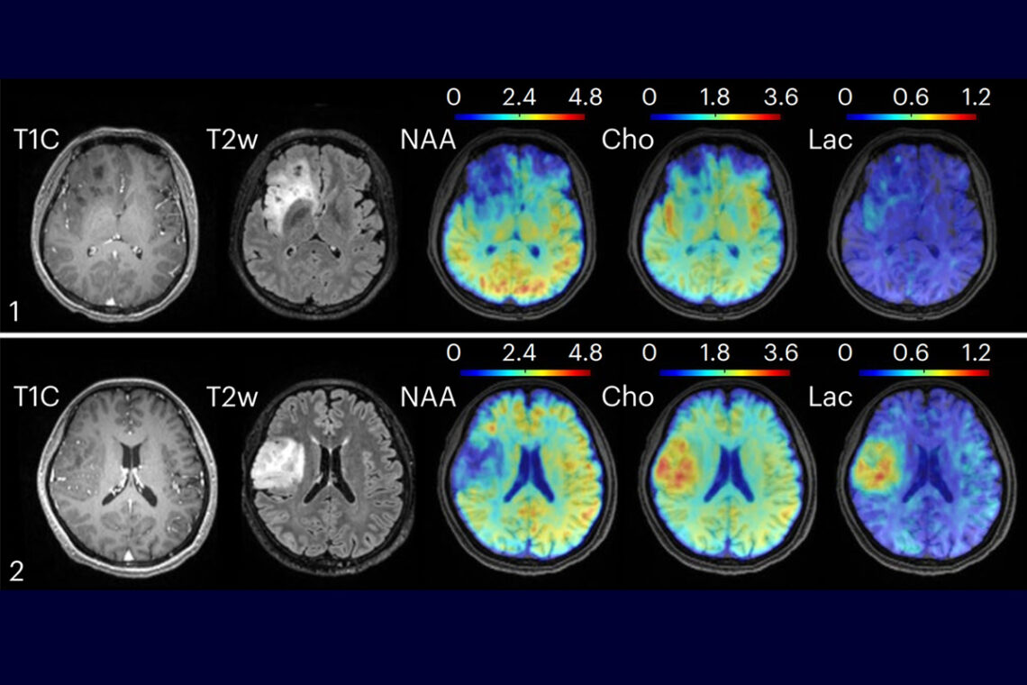 Rows of MRI images from two patients with brain tumors
