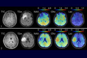 Rows of MRI images from two patients with brain tumors