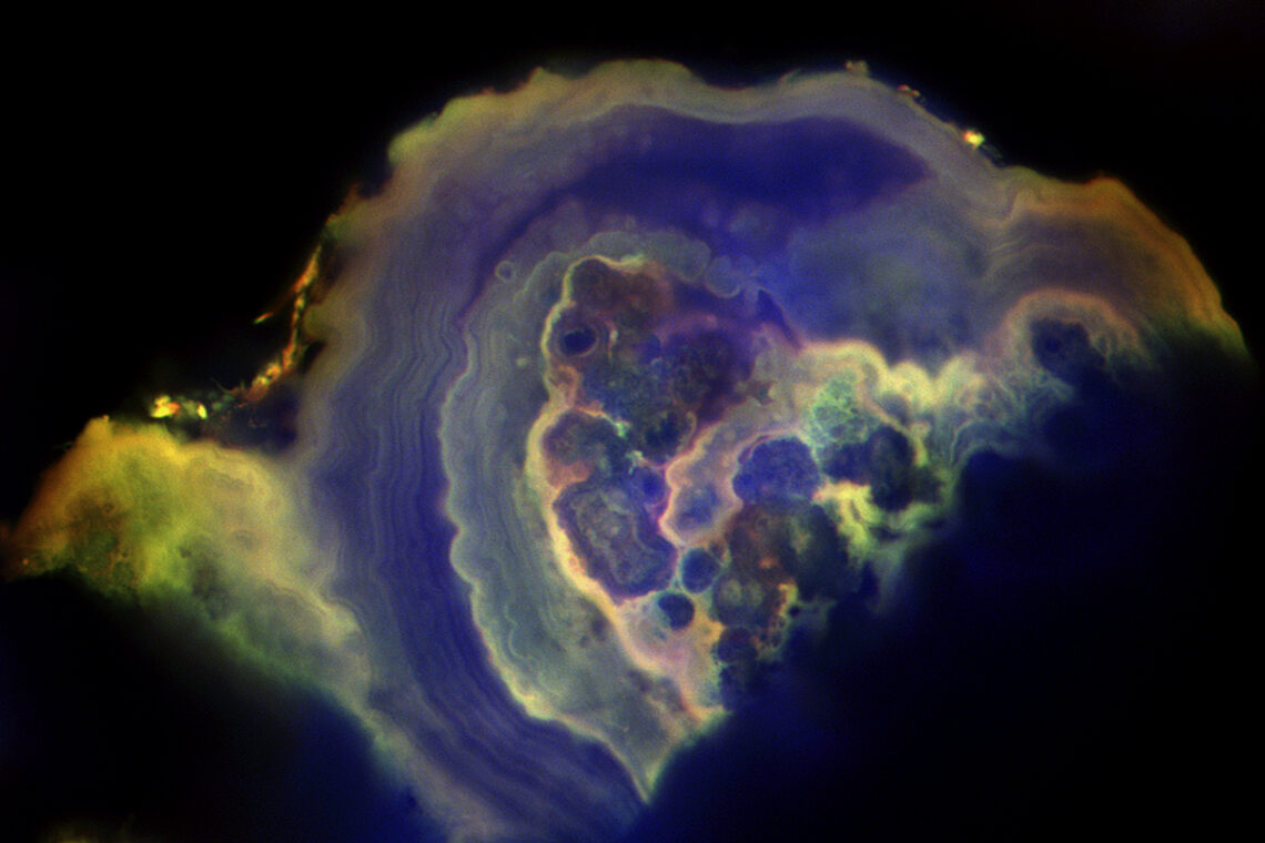 A microscope image of a cancerous calcification