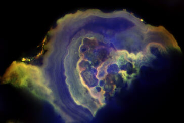 A microscope image of a cancerous calcification