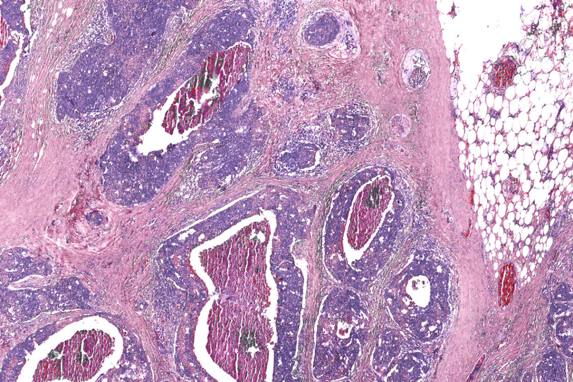 A tissue image of cancerous tumors