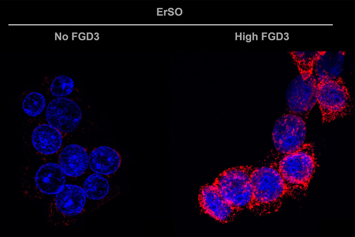 Micrographs of a cancer cell with no FGD3, left, and one with High FGD3, right. The image on the right is speckled with glowing red particles, the protein calreticulin, which presents on the cell surface, alerting immune cells that the cell should be targeted for destruction. 
